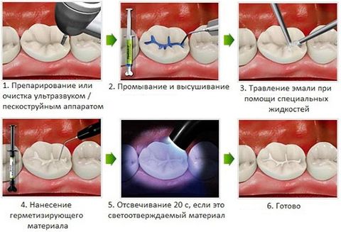 Герметизация фиссур