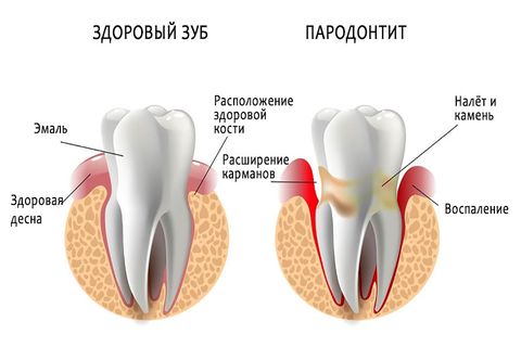 Пародонтит