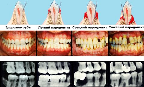 Пародонтит