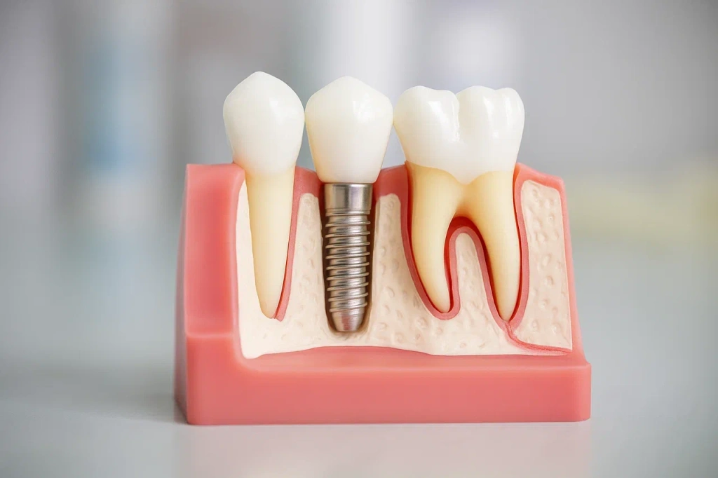 Имплантация зубов 