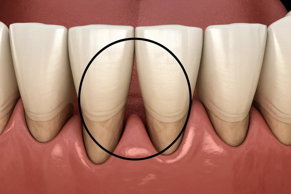 Пародонтит