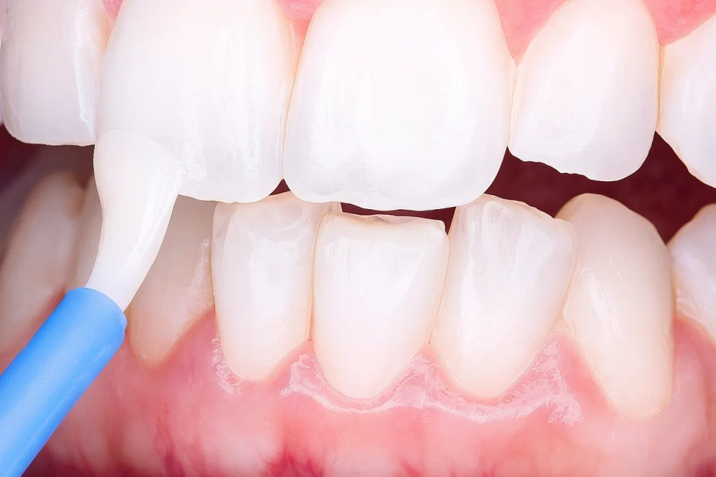 Фторирование зуба