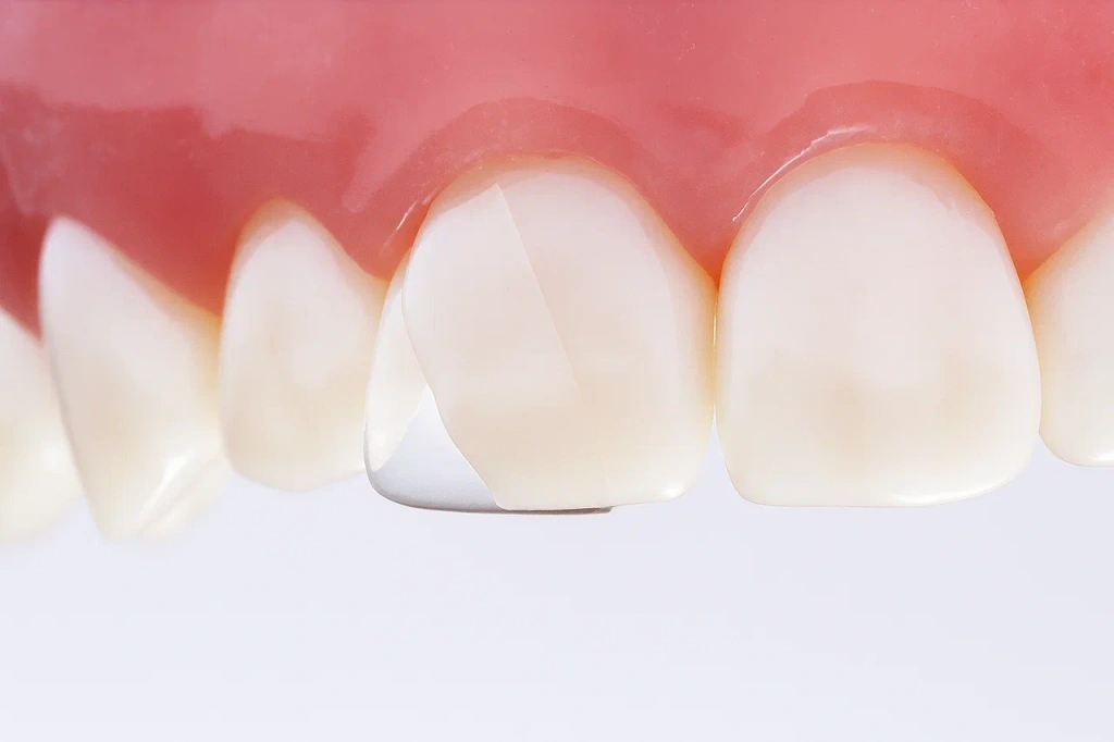 Восстановление эмали зубов