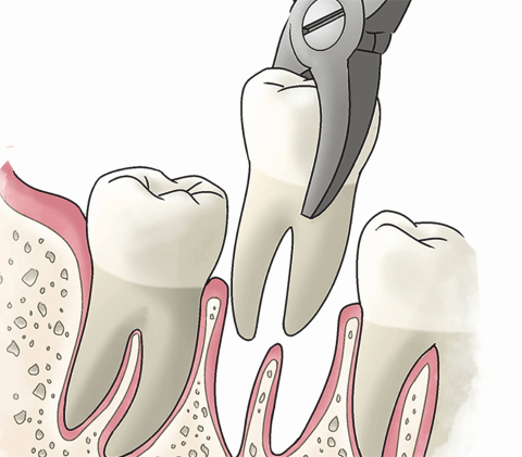 Удаление подвижного зуба