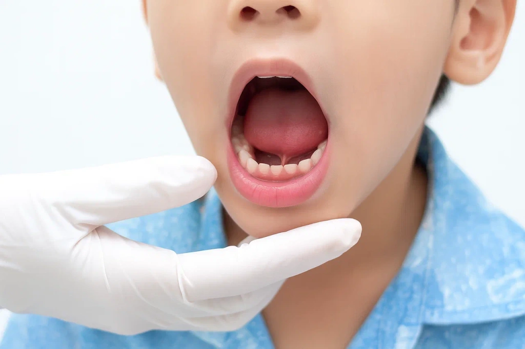 Пластика уздечки языка 