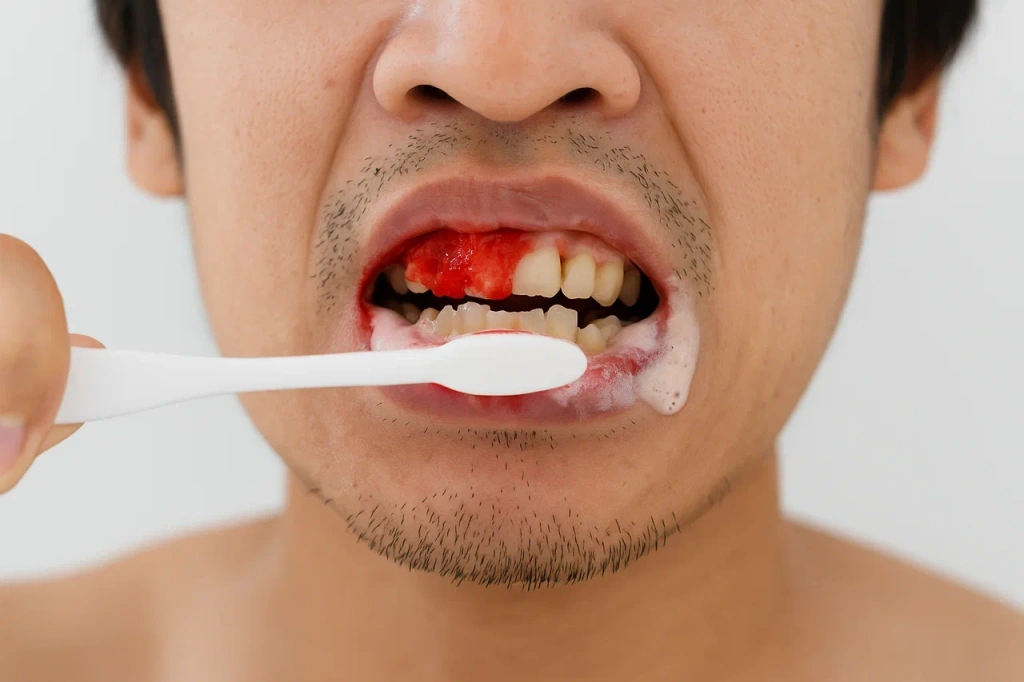 Лечение кровоточивости десен