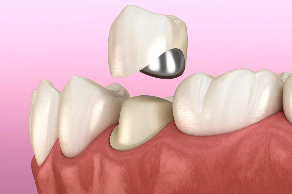 Металлокерамическая коронка