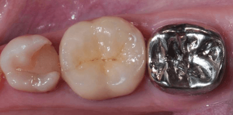 Металлические коронки на зубы — виды, установка, срок службы