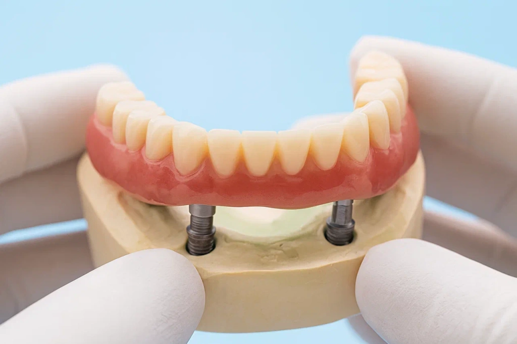 Мостовидный протез 