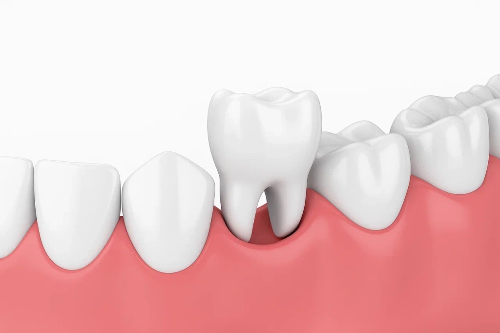 Аутотрансплантация зуба