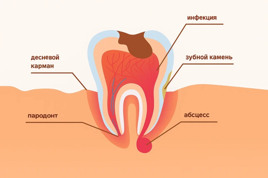 Лечение периодонтита