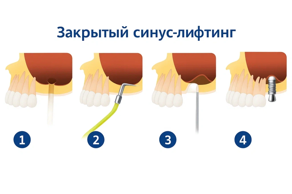 Эффект от закрытого синус-лифтинга