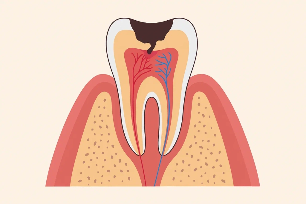 Почему развивается хронический пульпит