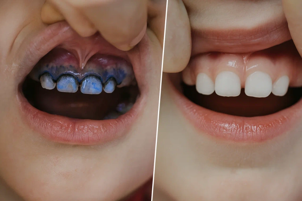 Серебрение молочных зубов