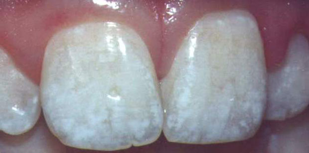 fluoroz1.jpg fluoroz1.jpg